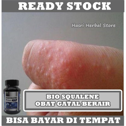 Obat Gatal Berair di Jari Tangan dan Kaki, Kutu Air, Bintik Bening, Berair, Bernanah - Bio Squalene