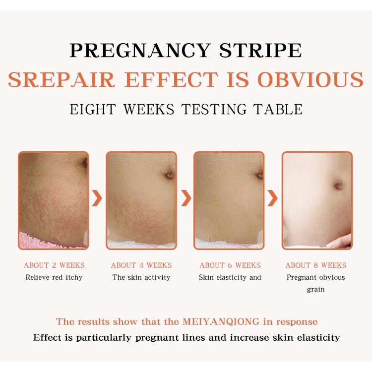 Penghilang strechmark  Strechmark cream Secara efektif menghilangkan stretch mark  Aman dan efektif