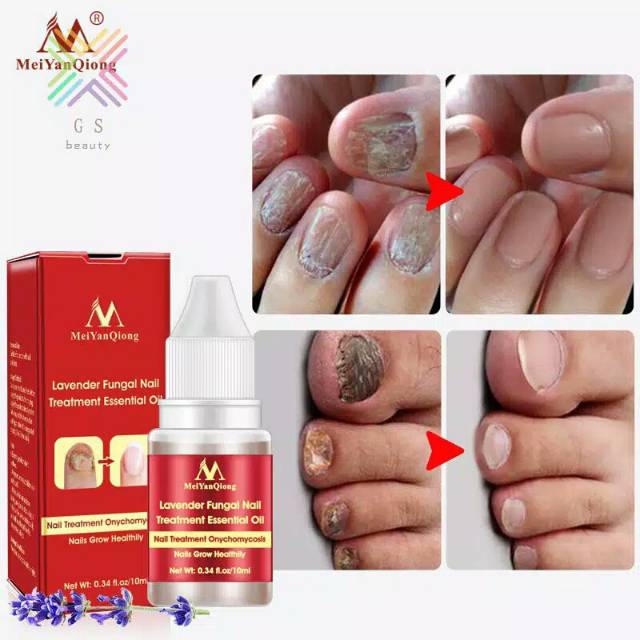 Anti Jamur Kuku Meiyanqiong Nail Fungus Treatment Anti Fungal Toenail Repair Kuku Jari Shopee Indonesia