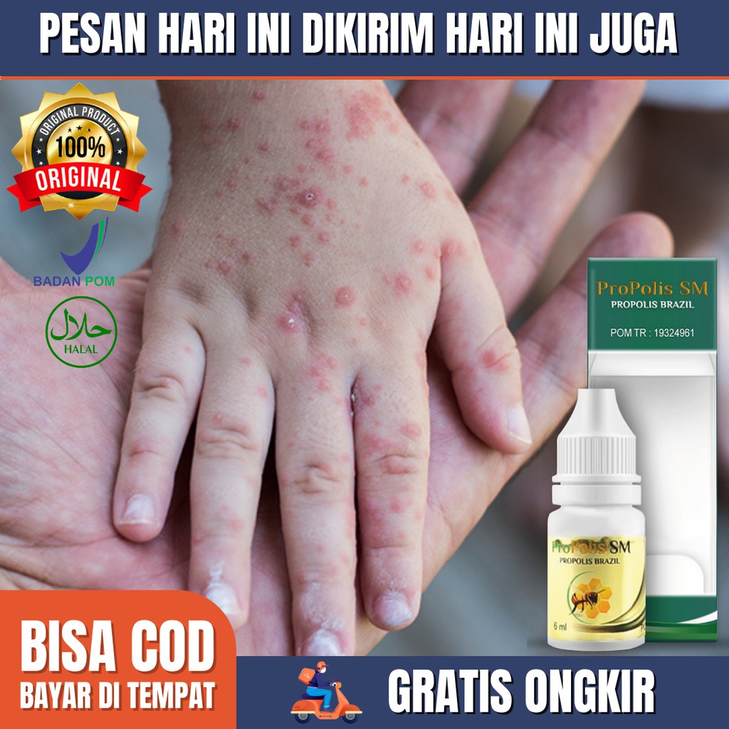 Obat Gatal Salep Gatal Kulit Gatel Selangkangan Jerawat Eksim Jamur Kulit Gatal Bintik Bintik Merah,