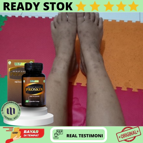 koreng, koreng di kaki, korengan, penghilang koreng, bekas koreng membandel