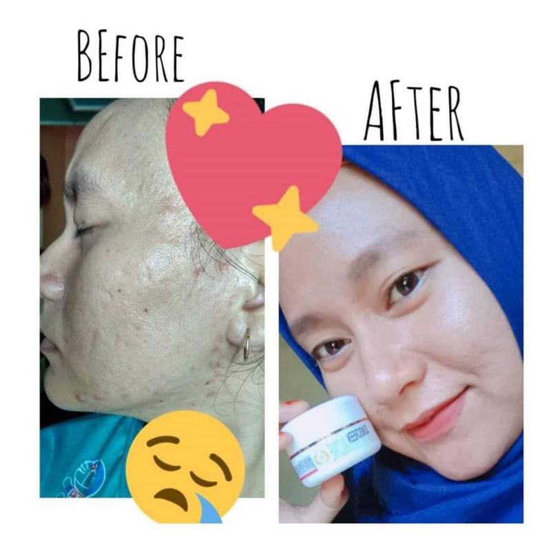 Paket ACNE D'LA Skincare