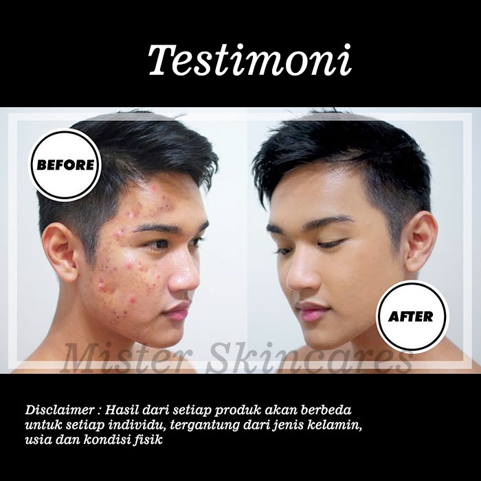 Clorismen Acno Gel - Acne Spot Treatment Obat Jerawat Pria