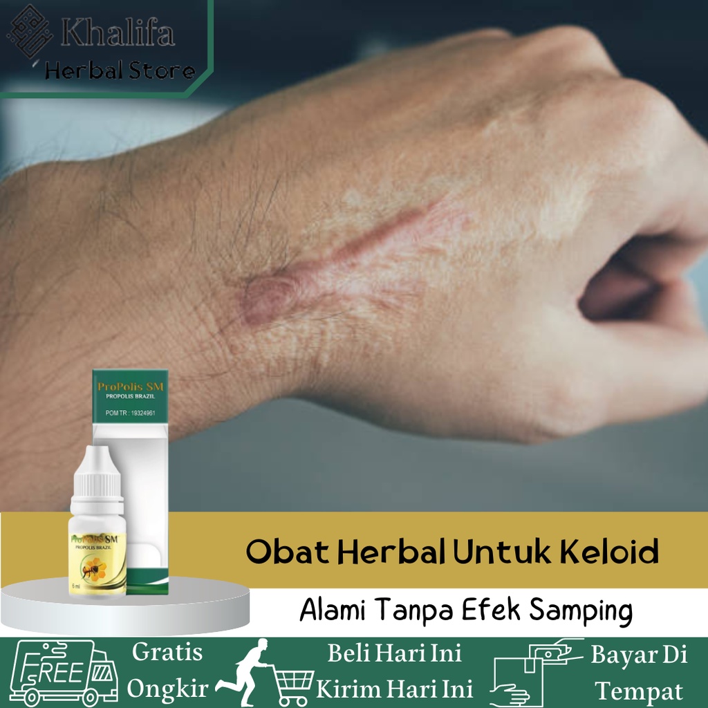 Obat Keloid, Obat Penghilang Benjolan Keloid, Obat Benjolan Keloid, Obat Bekas Luka Yang Menonjol, O