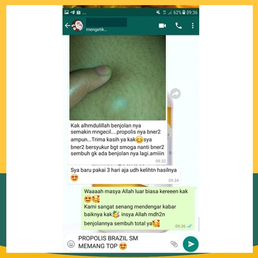 Obat Tetes/Oles Kista Tumor Benjolan Di Ketiak Payudara Tangan/Lengan Herbal Propolis SM Aman Untuk Anak Dan Dewasa