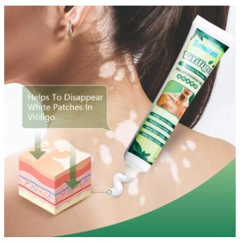 Sumifun Cream Salep Vitiligo Antibakteri Vitiligo White Spot Repigmentation - Salep Krim Penghilang Vitiligo Bintik Putih