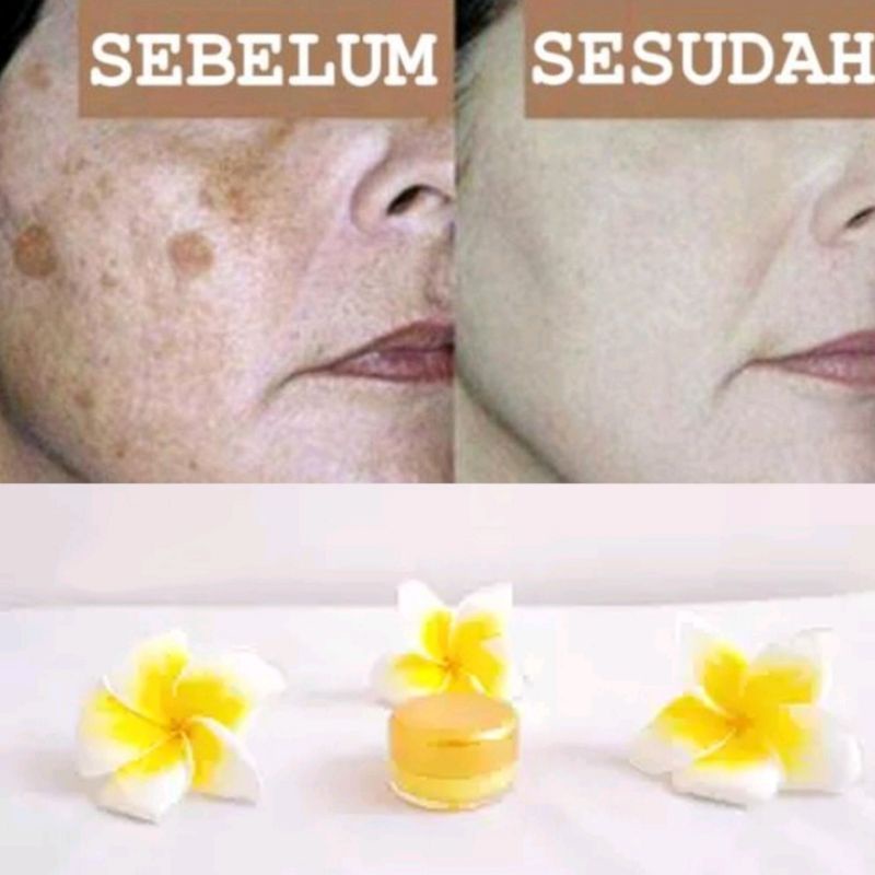 Salep Flek Menghilangkan Flek Hitam Membandel - Salep Flek Melasma - Salep Flek Hitam