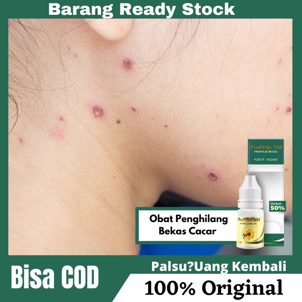 Obat Penghilang Bekas Cacar , Bekas Luka Cacar Di Wajah , Kaki , Bopeng | PROPOLIS SM 100% ASLI