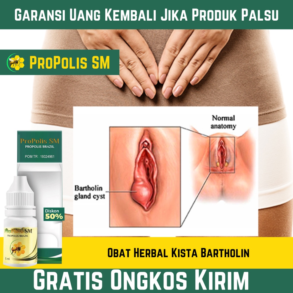 Obat Herbal Kista Bartholin , Kista Baker , Kista Dermoid , Kista Ganglion | PROPOLIS SM