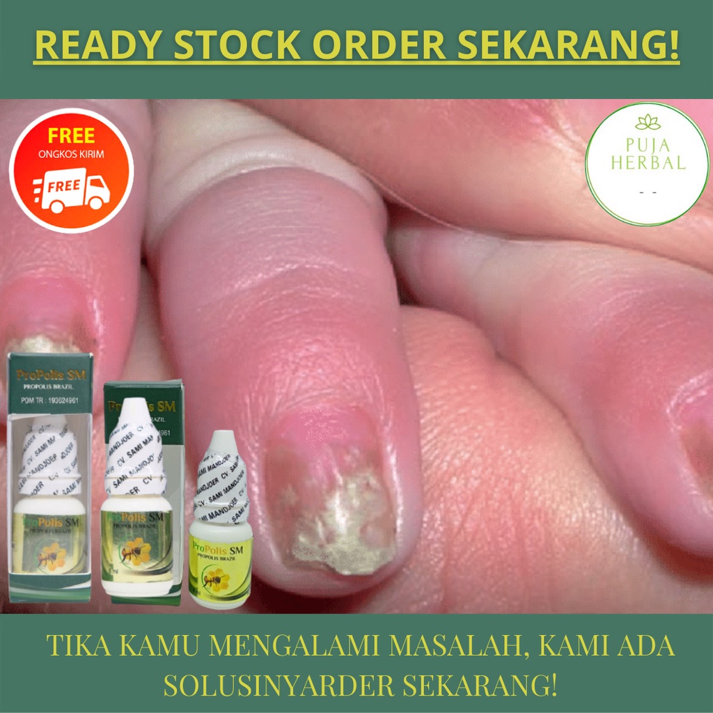 Obat Penumbuh Kuku, Infeksi Jamur Kuku, Obat Kuku Rusak, Vitamin Kuku Rusak, Obat Jamur Kuku, Jamur 