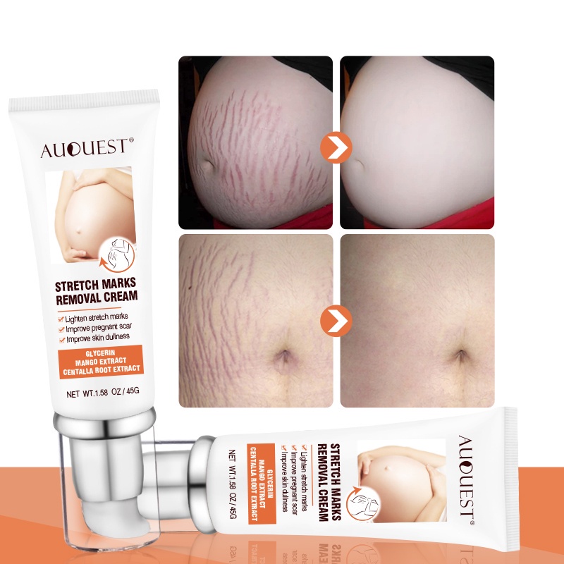 Penghilang strechmark  Strechmark cream Secara efektif menghilangkan stretch mark  Aman dan efektif