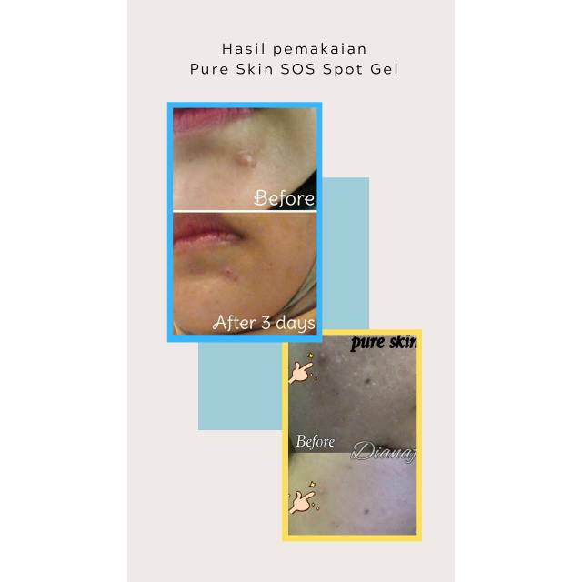 Pure Skin Oriflame Anti Acne / Jerawat