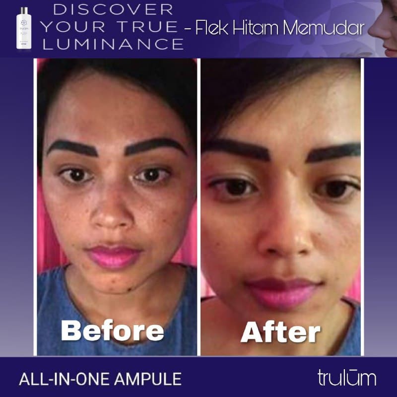 Skincare Herbal Alami Ampuh Obati Bekas Jerawat Flek HItam & Keriput