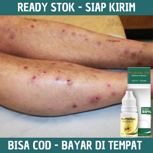 Obat Koreng Di Kaki, Penghilang Bekas Luka Di Kaki, Penghilang Bekas Koreng Di Kaki Cepat, Obat Kore