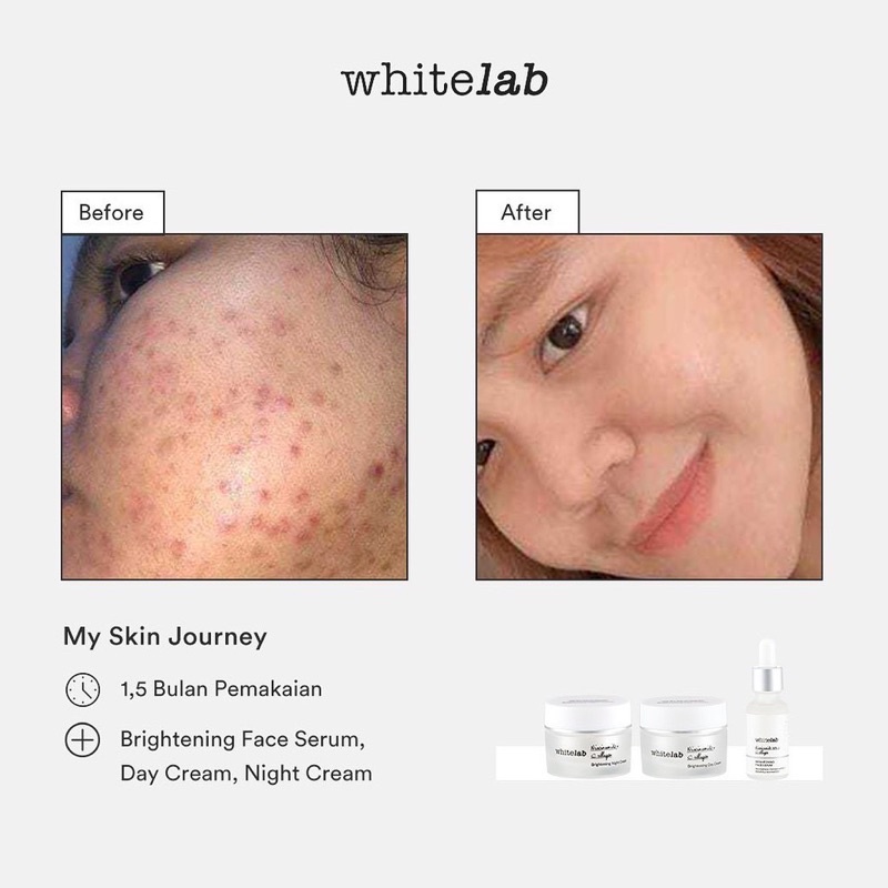 WHITELAB Brightening | Acne SERIES ( Facial Wash, Toner, Serum, Day Night Cream, Underarm, Acne Cream, Eye Cream, Whitelab Mugwort Masker, C dose, A dose, Ph Cleanser Whitelab)