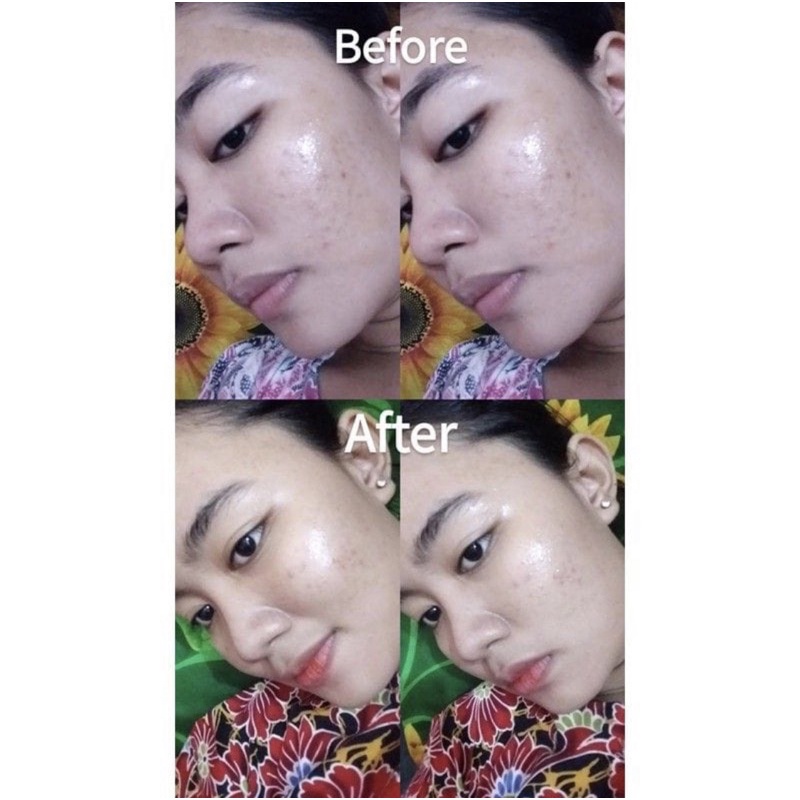 PERLE BEAUTE - Tamanu Oil 100% Murni Penghilang Flek Hitam Bopeng Bekas Jerawat Stertch Mark Aman Viral BPOM