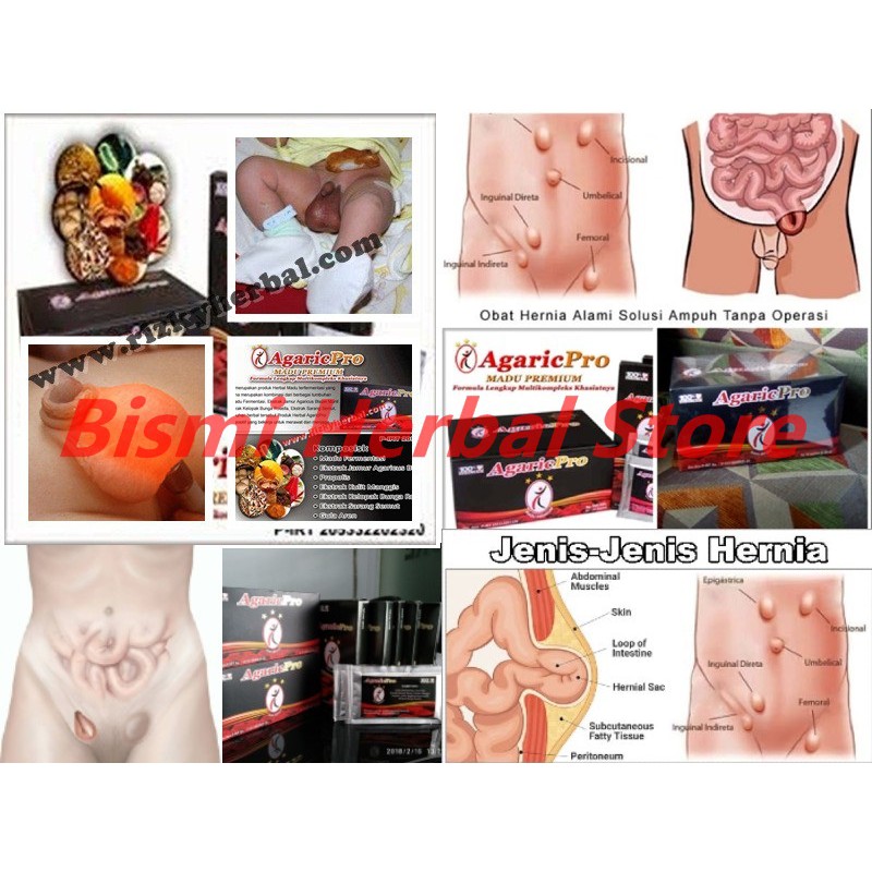 AGARICPRO OBAT HERBAL HERNIA ANAK AMPUH AGARICPRO 10 SACHET SYRUP MEMBANTU MENYEMBUHKAN HERNIA ANAK 