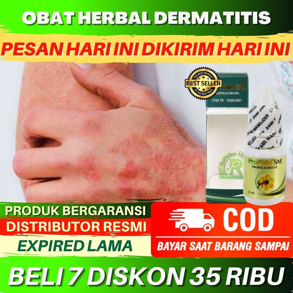 Obat Dermatitis Kronis Dermatitis Seboroik Dermatitis Atopik Dermatitis Perioral Dermatitis Stasis D