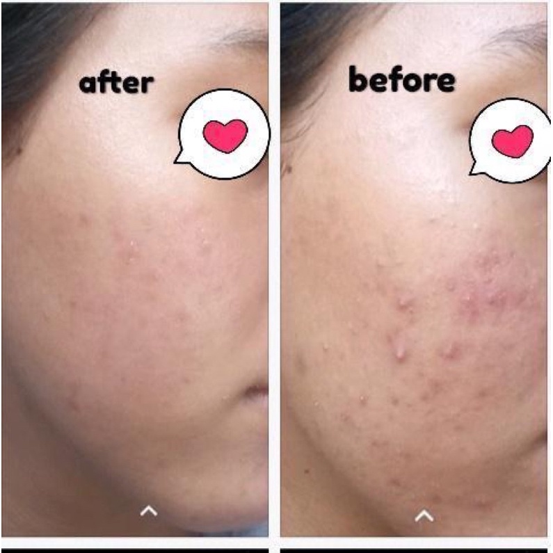 VAVL Facial cleanser / Blemish Facial Wash (60ml) BPOM,Sabun Pencuci Muka,Sabun Wajah Jerawat,Acne