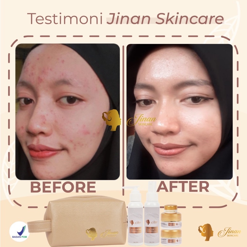 Paket Acne Jinan Skincare || Free Acne Spot Gell