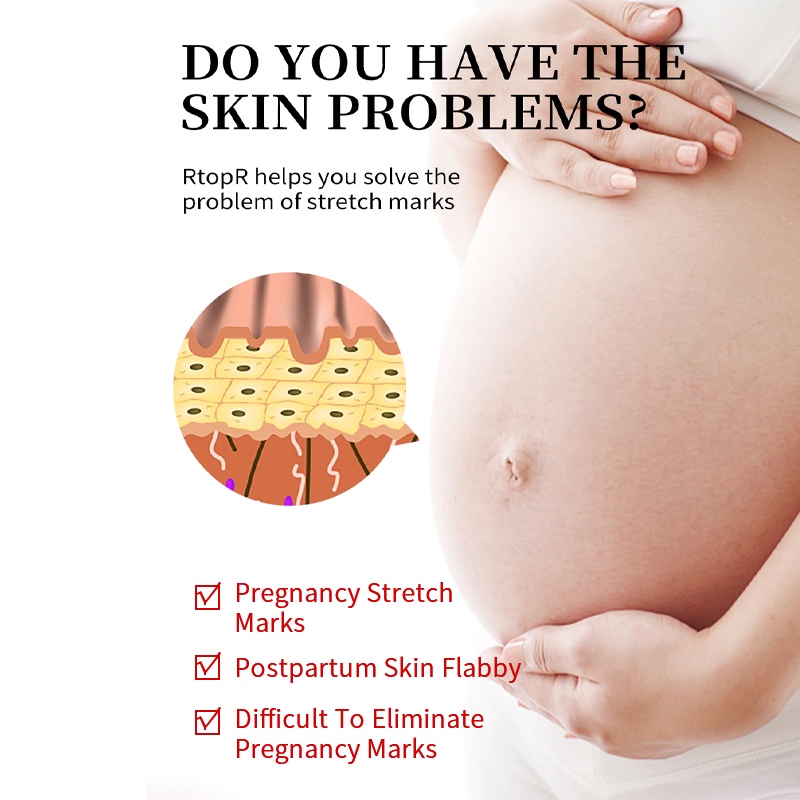 [Ori100%]RtopR Mango Pregnancy Scars Cream Maternity Repair Firming Enhance Skin Elasticity Stretch Marks Treatment Tubuh Postpartum Stretch Mark Perbaikan Krim Anti-Aging Kulit 40g