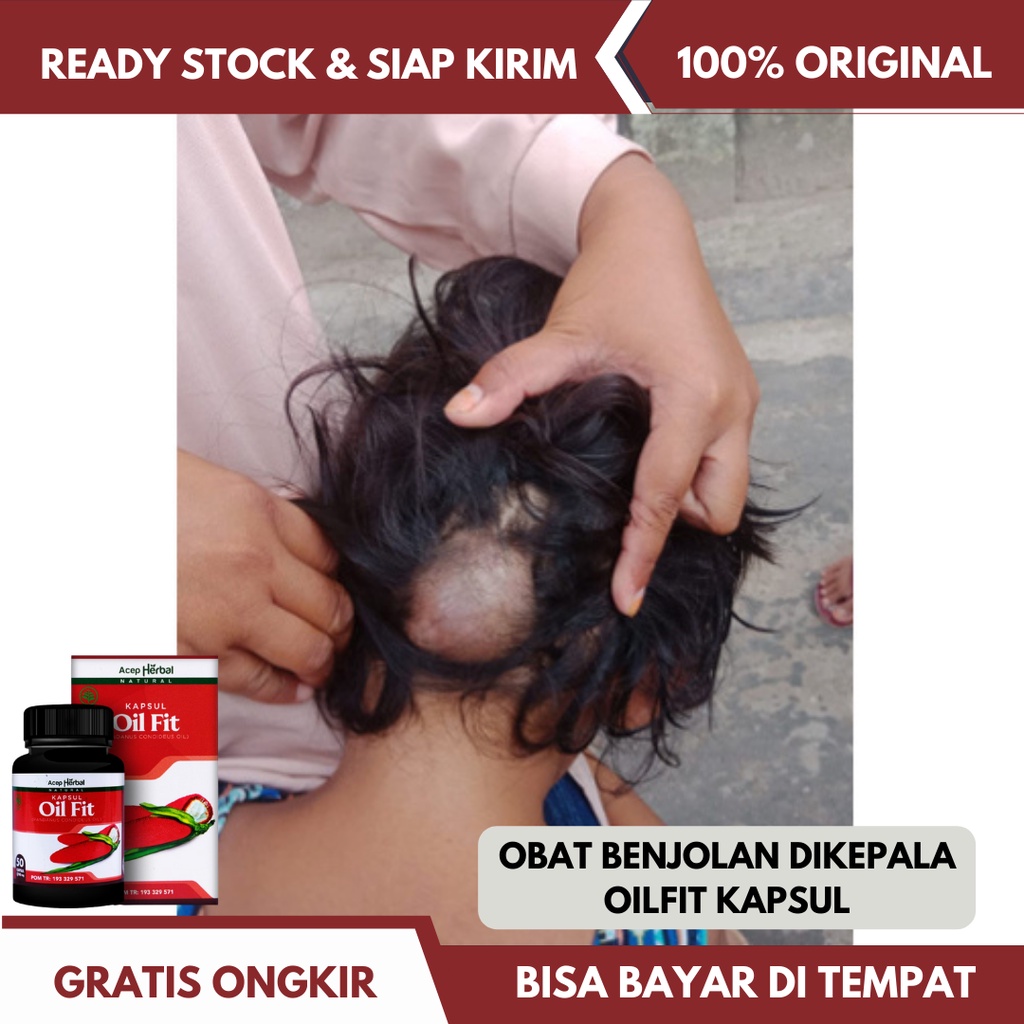 Obat Benjolan Di Kepala, Obat Lipoma Di Kepala, Obat Kelenjar Getah Bening di Kulit Kepala, Obat Tir