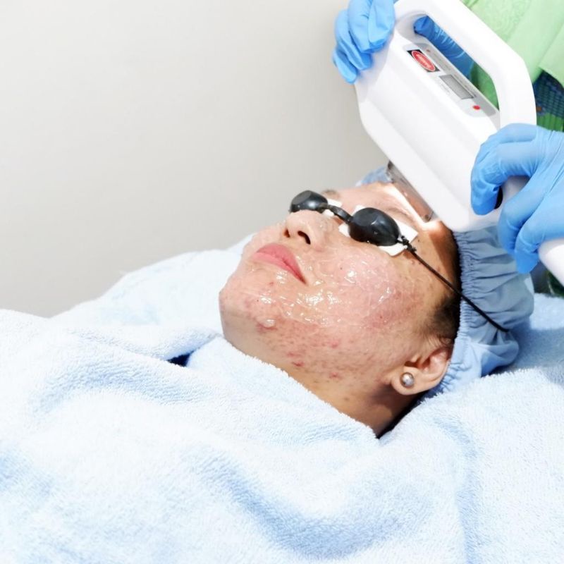 Laser IPL Jerawat / Laser Acne IPL / Treatment Laser Acne / Perawatan Wajah