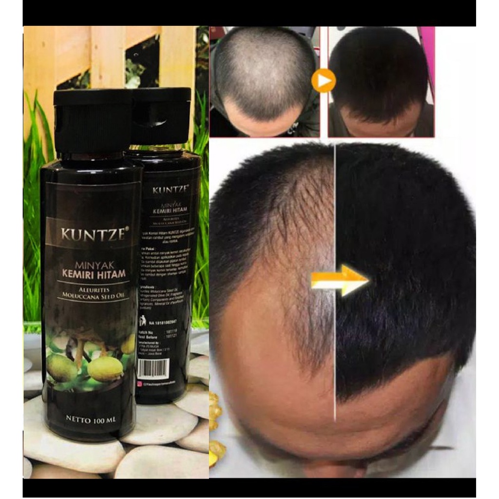 Minyak kemiri perawatan rambut rontok / Minyak kemiri anti botak / Kuntze minyak kemiri / Minyak kemiri penyubur rambut / Penumbuh rambut / Minyak kemiri hitam original BPOM