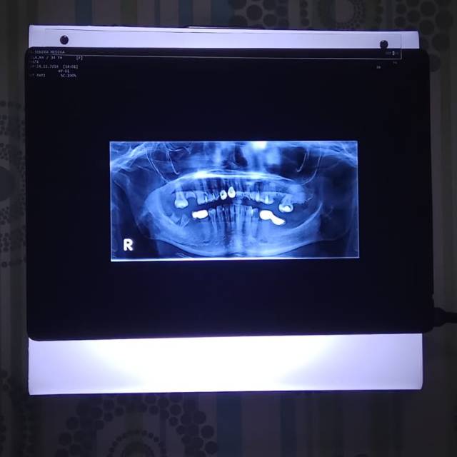 RONTGEN VIEWER PORTABLE 35X32