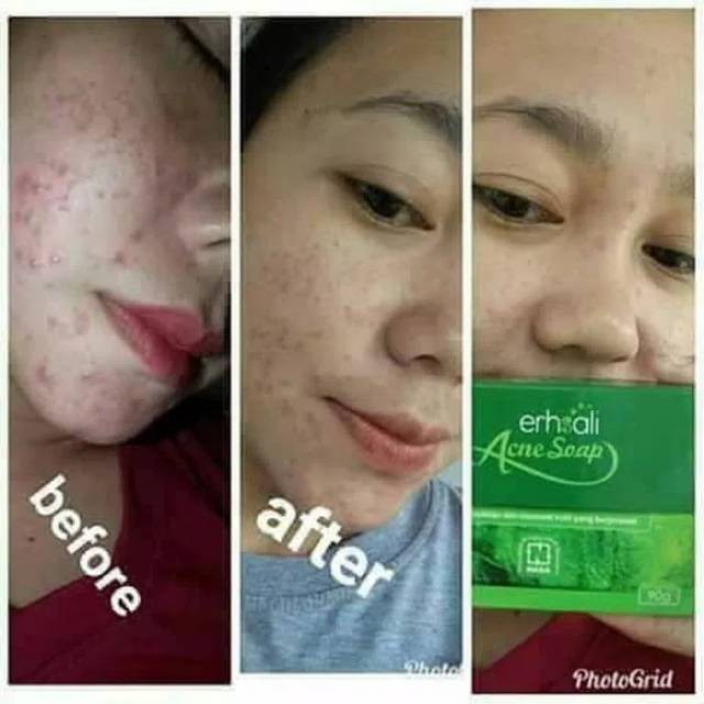 Erhsali Anti Acne Nasa  Sabun Jerawat Nasa(Produk Ori)