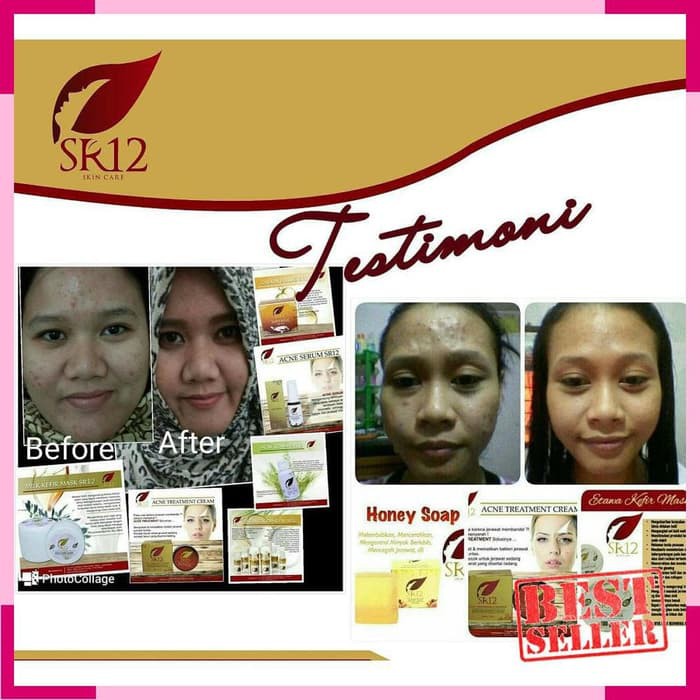 Sr12 Acne Treatment Cream - Perawatan Jerawat Untuk Muka Wajah - Sr12 Diskon