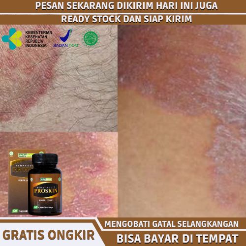 Obat Gatal Selangkangan, Obat Herbal Selangkangan Gatal, Obat Jamur Di Selangkangan, Obat Infeksi Ku