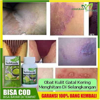 Obat Kulit Gatal Kering Dan Menghitam Di Selangkangan - Penghilang Gatel Jamur, Eksim, Infeksi Kulit
