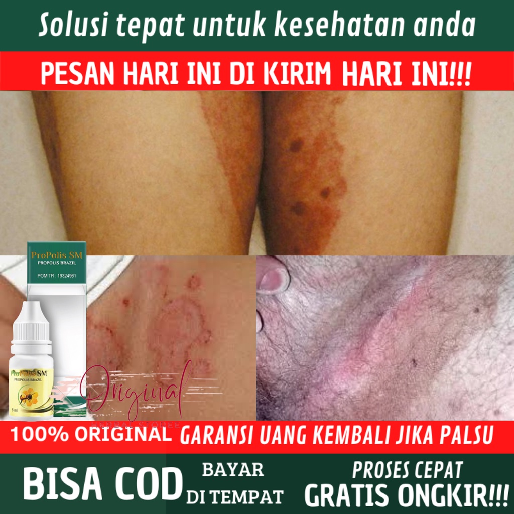 Obat Iritasi Selangkangan, Obat Selangkangan Sakit dan gatal, Obat Babak di selangkangan, Obat Gatel