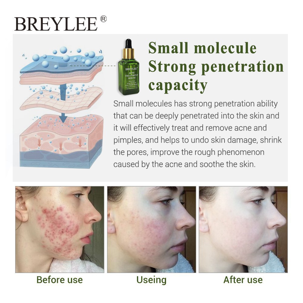 [BPOM] BREYLEE Acne Serum Treatment - Wajah Berjerawat (17ml) serum jerawat-3