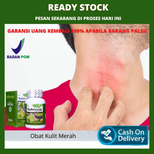 Obat Kulit Merah, Obat Kulit Gatal Merah Panas Seperti Terbakar, Obat Kulit Merah Merah, Bintik Ruam