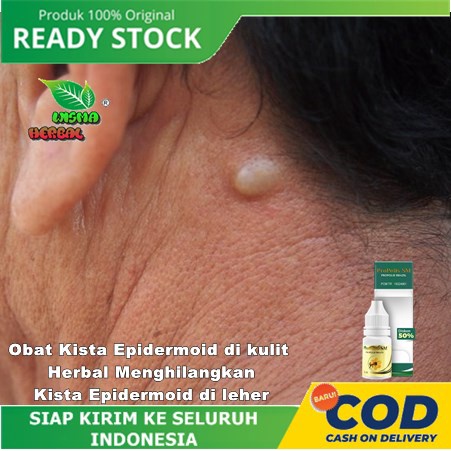 Obat Kista Epidermoid di kulit - Herbal Menghilangkan Kista Epidermoid di leher - Propolis SM Brazil