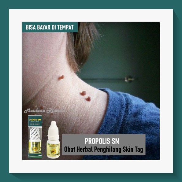 Obat Skin Tag, Daging Tumbuh, Papiloma, Kutil, Obat Penghilang Skin Tag Walatra Propolis SM