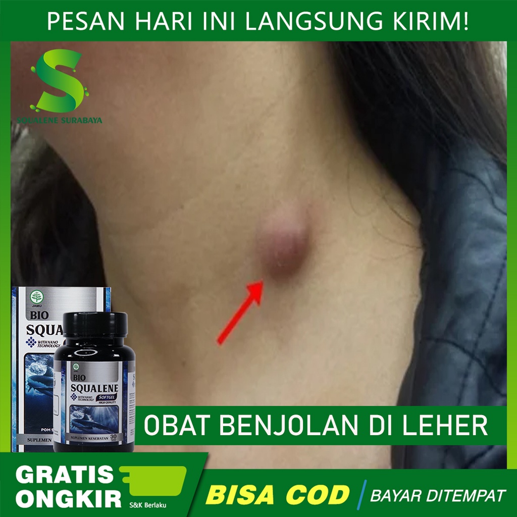 Jual Obat Benjolan Di Leher, Benjolan Di Tubuh,Punggung, Tangan, Jidat ...