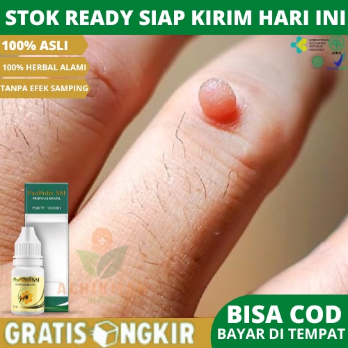Obat Papiloma, Obat Kutil, Obat Perontok Kutil, Obat Penghilang Kutil, Obat Daging Jadi, Obat Daging
