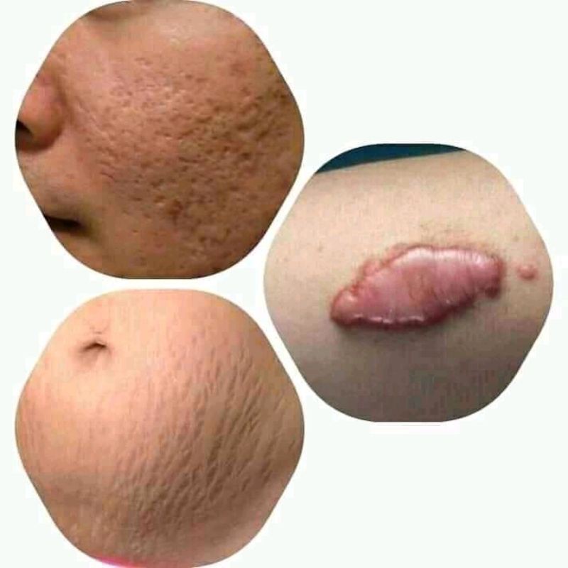 PENGHILANG BOPENG, JERAWAT BEKAS LUKA (VITALINE)