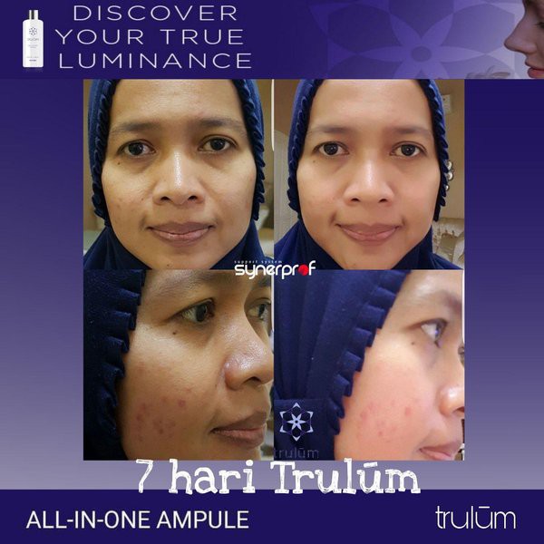 

Promo Spay Instant Glowing Atasi Bopeng Bekas Jerawat Halal BPOM terlaris