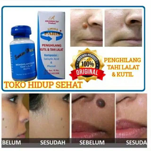 Penghilang kutil dan tahi lalat secara permanen