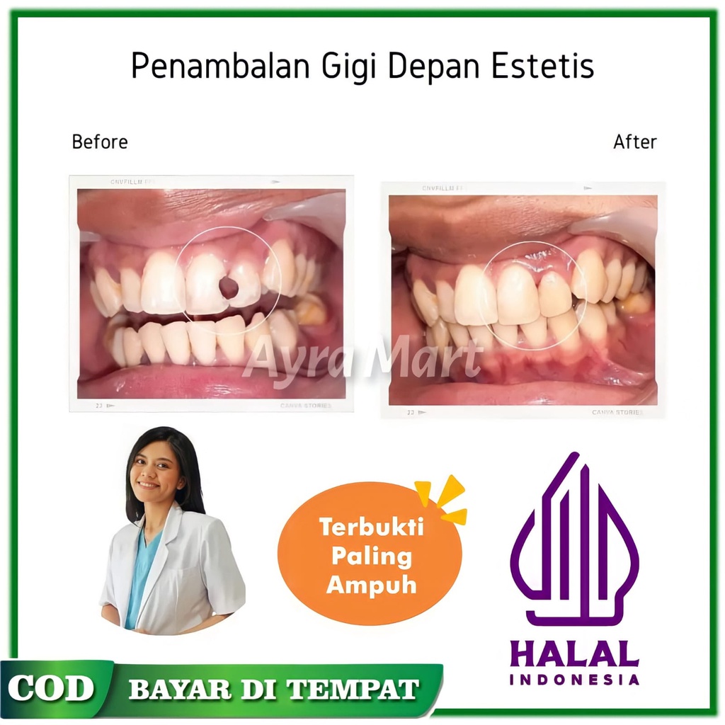 DAPAT 2 PCS !! PERMANEN Gigi Palsu Penutup Ompong Depan Penambal Gigi Berlubang Permanen ORIGINAL 10