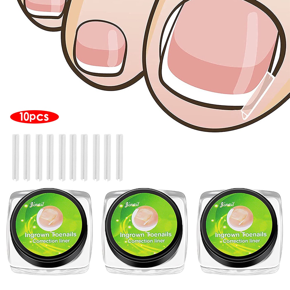 10pcs / set Klip Korektor Kuku Kaki Paronychia Flexible Portable Sekali Pakai