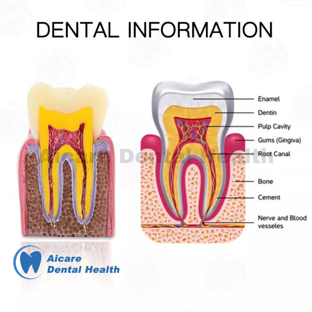 Dental Model 6X Tooth Decay 2 Side - Model Gigi Karies 6X 2 Sisi