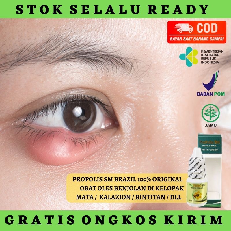 PROPOLIS SM 100% ASLI - Obat Penghilang Benjolan di Kelopak Mata - Obat Pengempis Benjolan di Kelopa