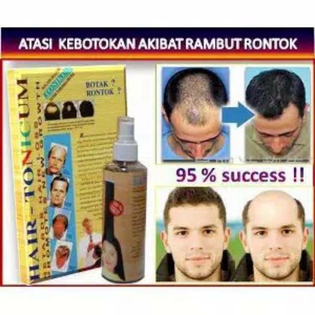 Jual TERBUKTI PALING CEPAT Obat penumbuh rambut rontok botak kering