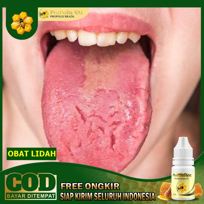 Obat Herbal Lidah Perih Lidah Pecah Pecah Obat Sariawan Lidah Propolis Sm Shopee Indonesia