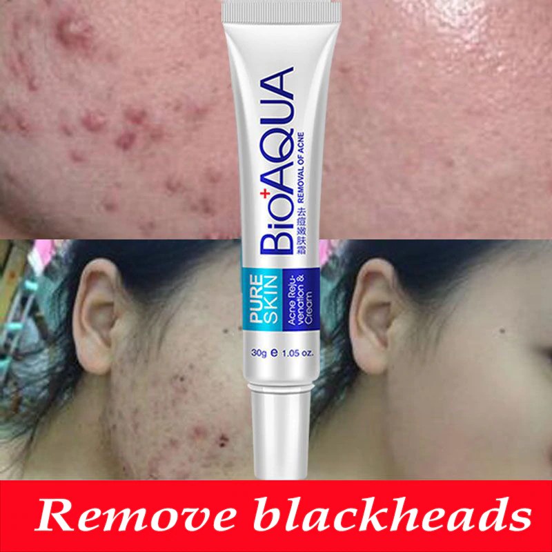 Bioaqua 30g Acne Treatment Blackhead Remova Anti Acne Cream Oil Control Shrink Pores Acne Scar